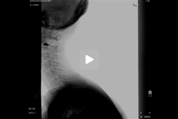 嚥下造影検査（VF）